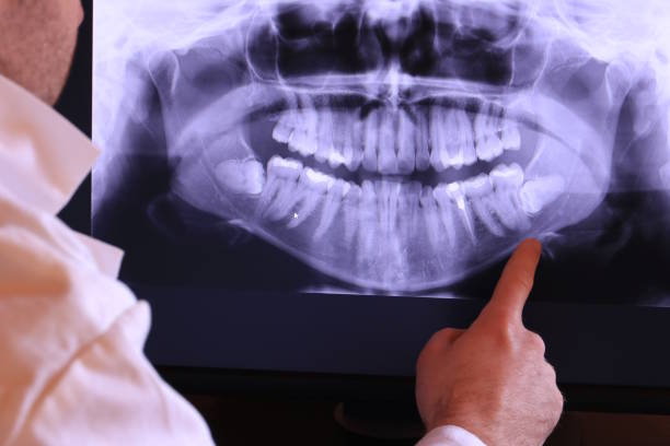 Best Emergency Root Canal Treatment in Eggertsville, NY