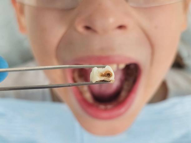 Best Emergency Tooth Extraction in Eggertsville, NY
